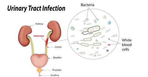 Urinary Tract Infections Utis Symptoms Causes Life Health Max