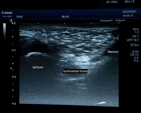 Randomized Controlled Trial Rct Comparing Ultrasound Guided Pudendal Nerve Block With