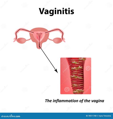 Vector Clipart Inflammation Of The Vagina Vaginitis Infographics