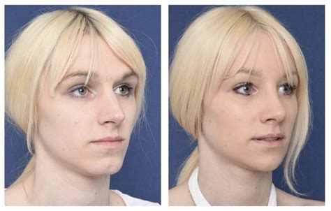 What You Should Know About Facial Feminization Surgery Wild About Beauty