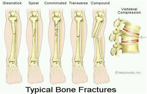 Pin By Lee Anne Conners On Surg Tech Bone Fracture Fracture