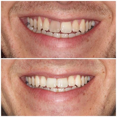 Dental Work Before After Pictures Smiling Dental