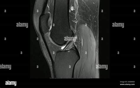 Magnetic Resonance Images Of The Knee Joint Sagittal Proton Density Images In Cine Mode Mri