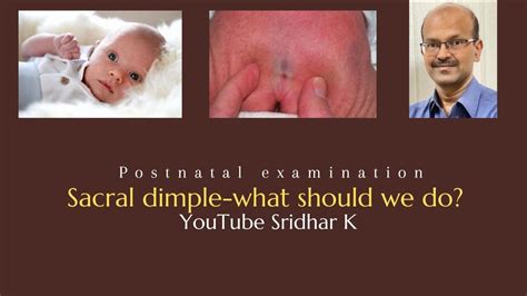 Sacral Dimple Is It Significant What Should We Do To Manage Sacral Dimple Dr Sridhar K Youtube