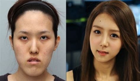 South Koreans Before And After Plastic Surgery Korean