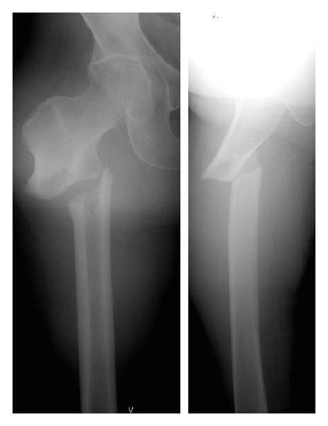 Radiographs From Case Examples With Atypical Subtrochanteric Femoral