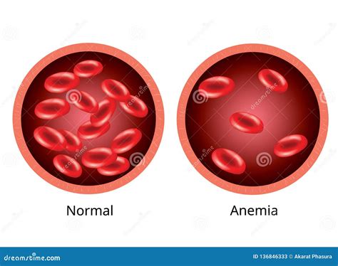 Blood Of Healthy Human And Blood Vessel With Anemia Stock Illustration