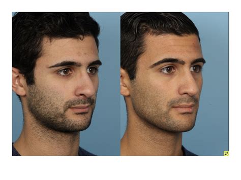Loss of smell is not a trivial effect of covid. Before & After Gallery | Male Rhinoplasty | Dr. Sidle Chicago