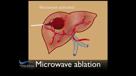 Now Were Cooking Microwave Ablation Of Liver Tumour Youtube