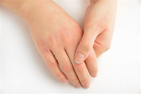Suffering From Dry Hands Here Are Some Tips To Relieve The Dryness