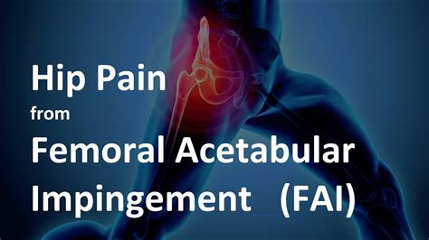 Hip Pain From Femoral Acetabular Impingement Fai What Is It And How To Treat It Youtube