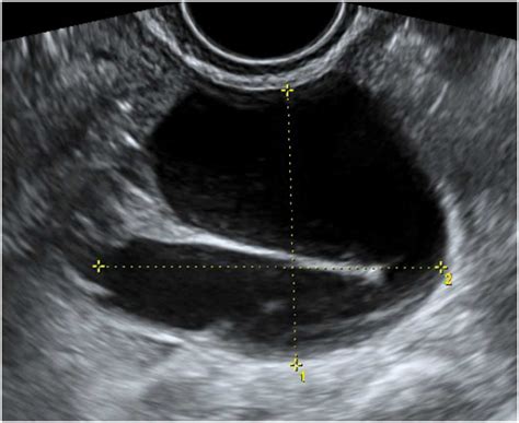 Fallopian Tube Cyst Ultrasound
