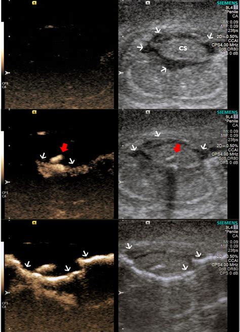 Microbubble Enhanced Ultrasound To Demonstrate Urethral Transection In