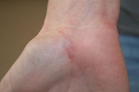 Small Itchy Bumps On Hands And Feet Causes Treatments