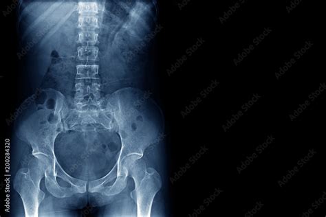 X Ray Image Of Human Normal Spine Rips Pelvis Both Hip Joint And