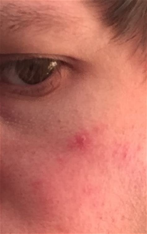 Red Spot Mark On Face For Years Wont Go Dermatology