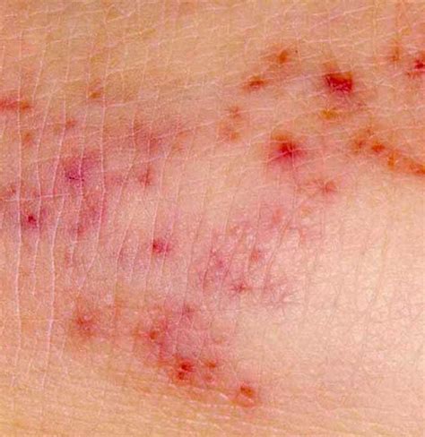 Meningitis Rash Pictures Symptoms And Similar Rashes