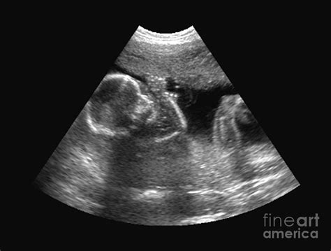Ultrasound Of Fetus Photograph By Medical Body Scans