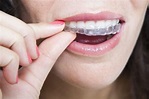 鋼絲牙套VS隱形牙套，究竟哪種適合你？ - 每日頭條