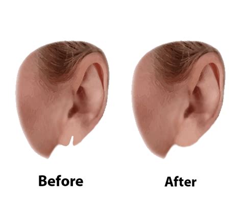 Ear And Earlobe Surgery Visage Facial Plastic Surgery