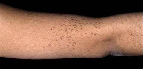 Management Of Cutaneous Viral Warts The Bmj