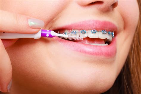 5 Tips For Caring For Your Braces