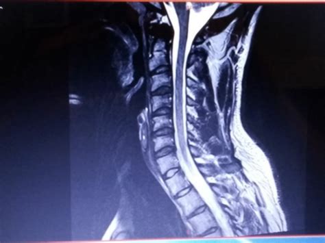 Mri Of Neckplease Help Other Conditions And General Health