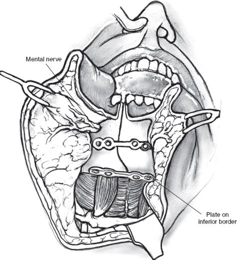 Atlas Of Salivary Gland Surgery Pocket Dentistry