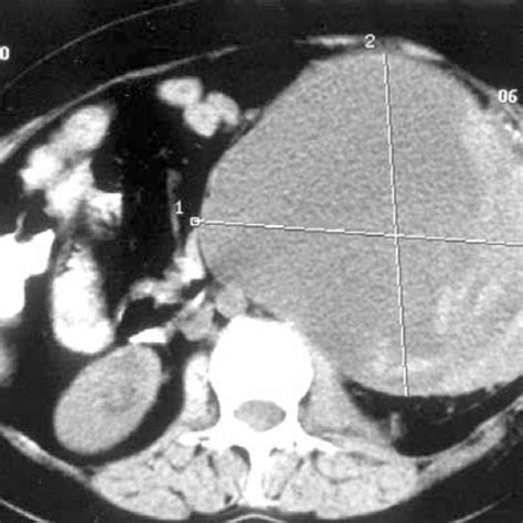 Ct Image Showing A 19 X 14 X 17 Cm Left Retroperitoneal Mass With Solid