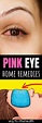 Get rid of pink eye fast with these 6+ home remedies - Way to Steel ...