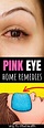 Get rid of pink eye fast with these 6+ home remedies - Way to Steel ...