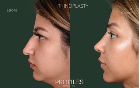 Rhinoplasty Before And After Photos Beverly Hills La Rhinoplasty