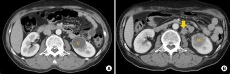 Computed Tomography Showing A Renal Cyst A A Kidney Mass With