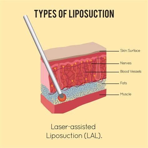 Types Of Liposuction Procedures Exquisite Bodies