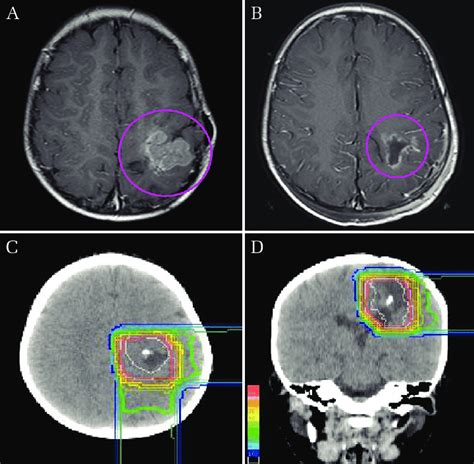 A 3 Year Old Boy Had A Parietal Lobe Tumor B Tumor Excision Was