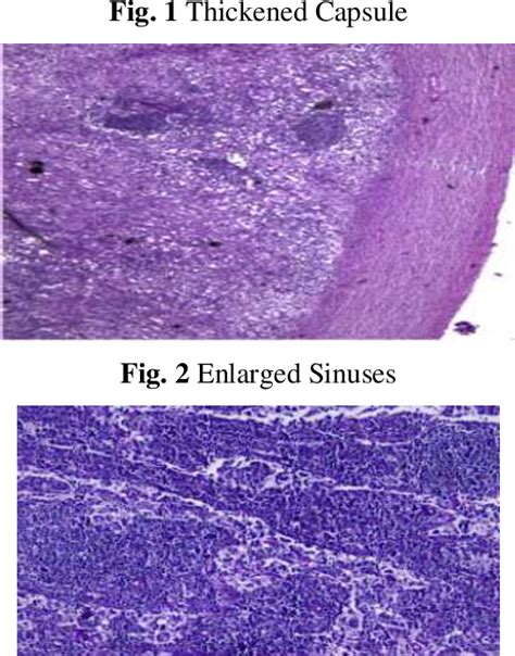 Figure 1 From Rosai Dorfman Disease A Rare Presentation Of Cervical