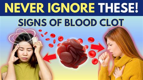 Dont Ignore Top 8 Warning Signs Of Blood Clots Youtube