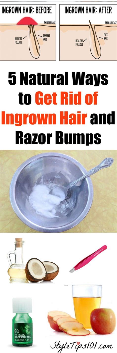 Ways To Get Rid Of Ingrown Hair Ingrown Hair Ingrown Hair Remedies