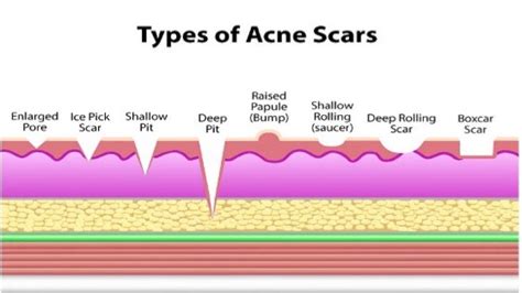 Acne Scar Treatment Cincinnati Acne Scar Lasers Fillers For Acne Scars