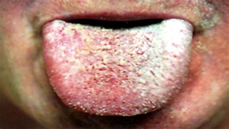 Home Remedies For White Coated Tongue Youtube