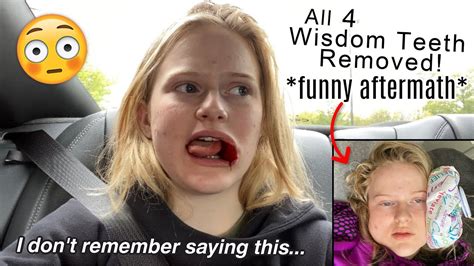 Wisdom Teeth Removal Aftermath Hilarious Youtube