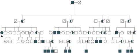 Choroideremia In A Woman With Turner Syndrome Ophthalmology Jama