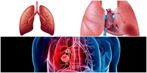 Tromboembolia Pulmonar TEP Síntomas Causas Diagnóstico Formación Fisiopatología y