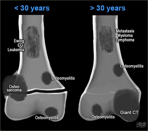 The Radiology Assistant Osteolytic Ill Defined Bone Tumors