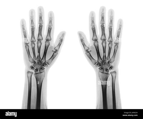Film X Ray Of Both Normal Human Hands Front View Stock Photo Alamy