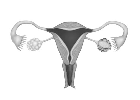 Bab 5 Kista Ovarium Jinak Melaka Fertility Selvas Fertility