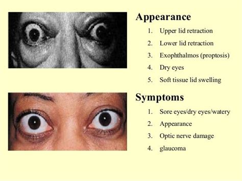 Exophthalmos Thyroid Eye Disease