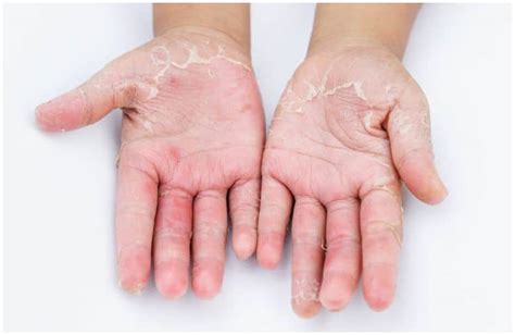 Contact Dermatitis Vs Scabies Differences Your Health Remedy