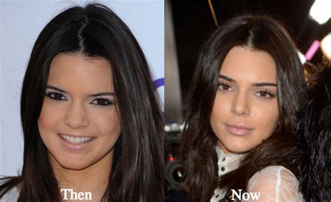 Did kendall jenner undergo plastic surgery? Kendall Jenner Plastic Surgery Lip Fillers Before and ...