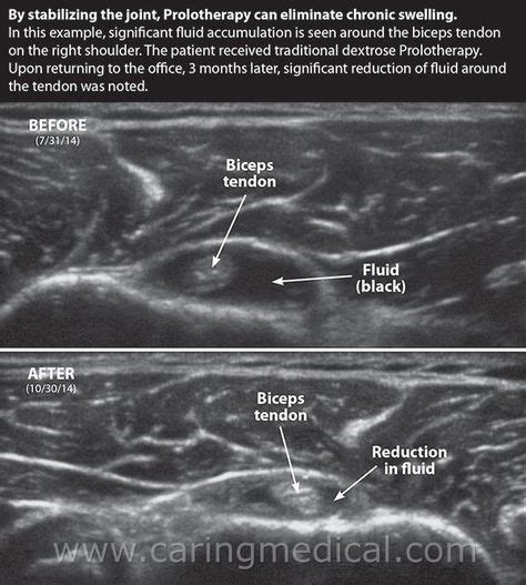 Biceps Tendon Ultrasound With Images Ultrasound Bicep Tendonitis